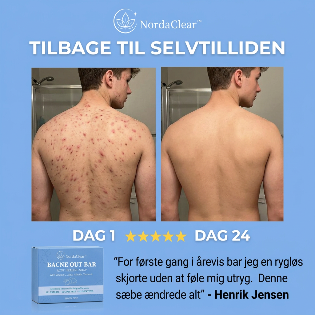 NordaClear™ | Sig farvel til akne på kroppen – på naturlig vis