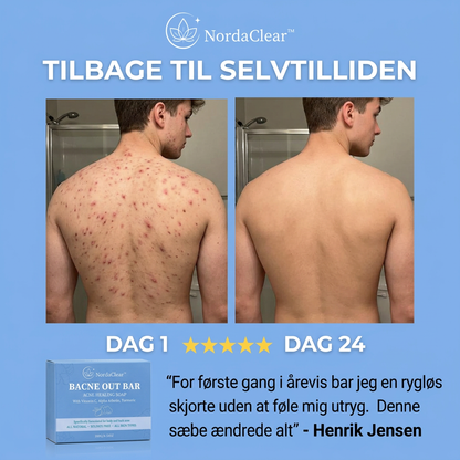 NordaClear™ | Sig farvel til akne på kroppen – på naturlig vis